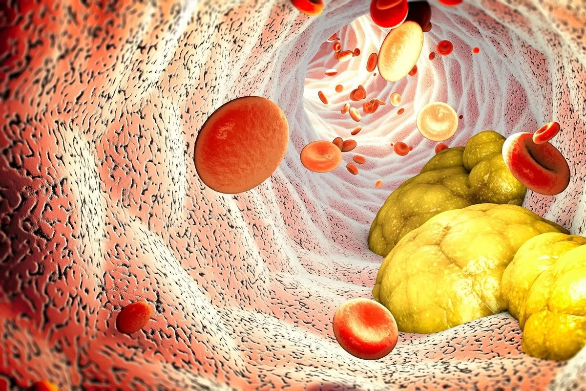 Zaburzenia lipidowe - co to znaczy i jak wpływają na zdrowie?