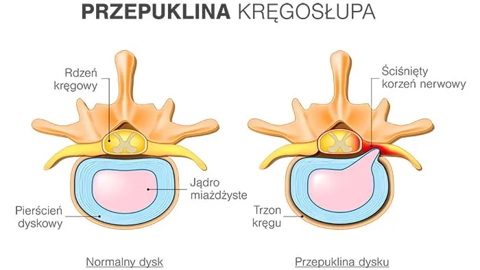 Jakie leki na przepuklinę lędźwiową mogą złagodzić Twój ból?